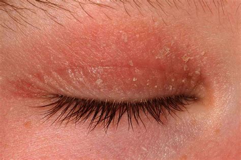 Photos of eyelid dermatitis - Eyelid dermatitis (eyelid eczema) can cause red, dry, itchy skin on and around the eyelids. Learn its types, causes and treatments.